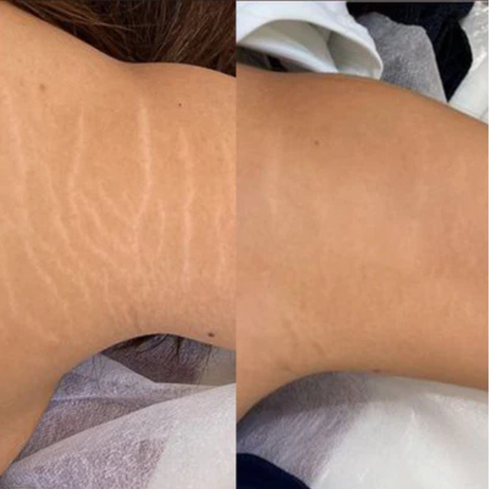 Magic Contour Oil – For Visible Cellulite Smoothing